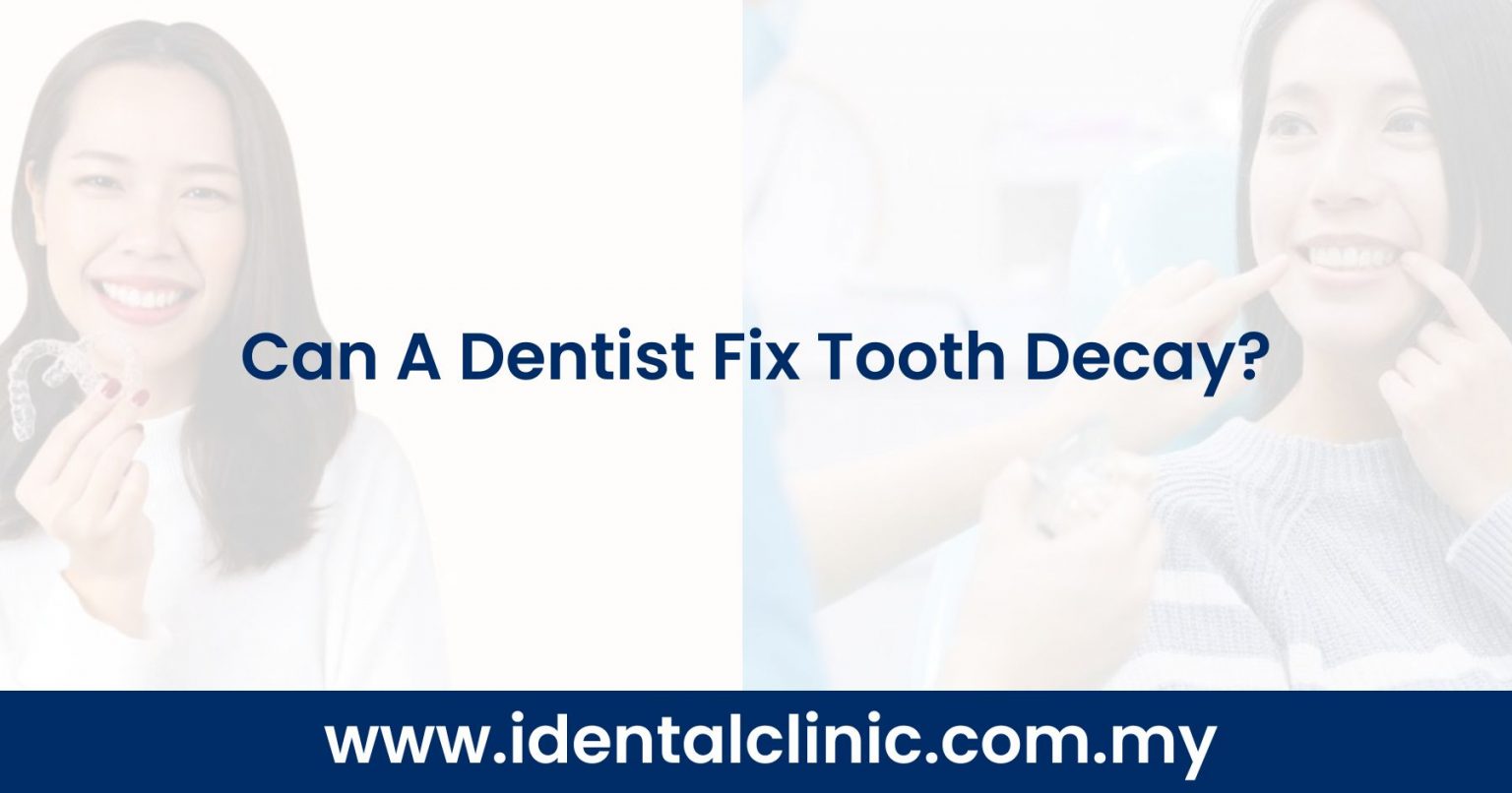 Can A Dentist Fix Tooth Decay? iDental Clinic