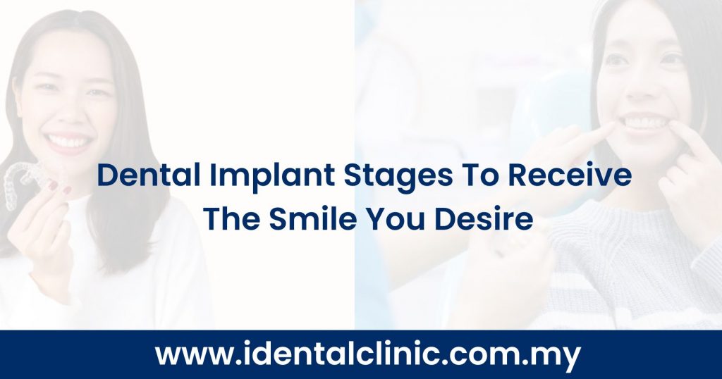 Dental Implant Stages To Receive The Smile You Desire