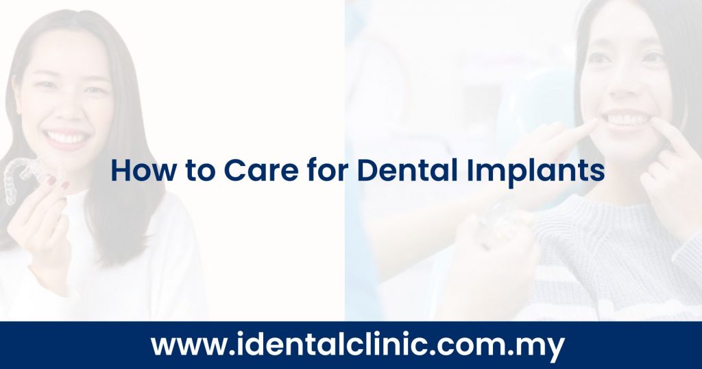 How to Care for Dental Implants