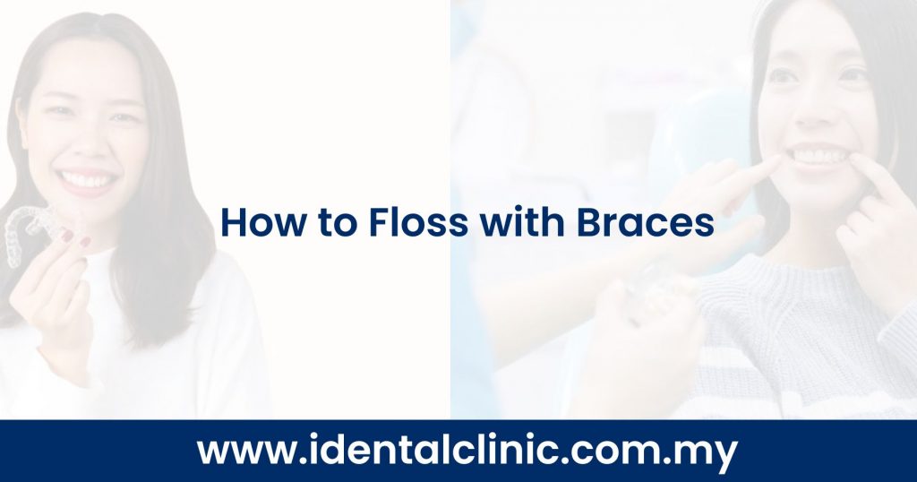 How to Floss with Braces